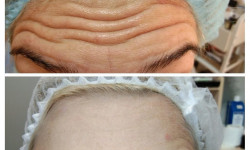 Ботулинотерапия Косметолог-ін'єкціоніст Виктория Харків