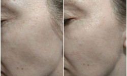 Биоревитализация Косметолог-ін'єкціоніст Виктория Харків