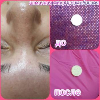 Микродермабразия. Глубокий механический пилинг