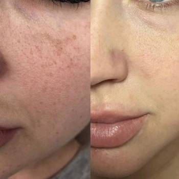 BB Glow Treatment - Эффект тонального крема (Ровный тон и си