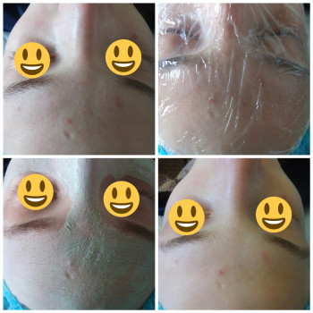 Чистка лица (механическая, ультразвуковая, комбинированная)
                    Мастер депиляции Ірина Киев