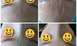 Чистка лица (механическая, ультразвуковая, комбинированная) Майстер депіляції Ірина Київ