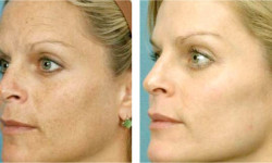 Химический пилинг лица Косметолог-ін'єкціоніст Наталия Одеса