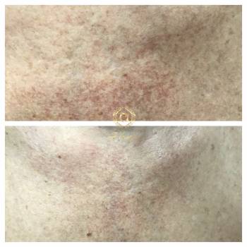 Куперозная сетка. Спустя три процедуры