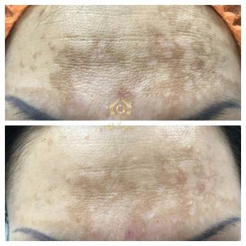 Гиперпигментация. 4 процедуры мезотерапии