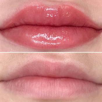 ПМ губ, фото до и после процедуры