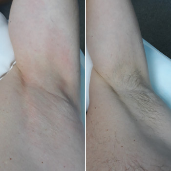 Мужской шугаринг. Подмышки. 100 грн.