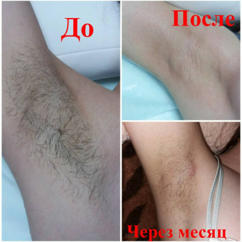 Стоимость 50 грн. Разница бритья и Шугаринга. Фото "ДО проце