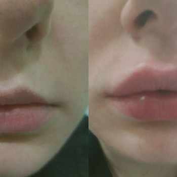 Объемно-контурная пластика: коррекция формы губ
                    Врач-косметолог Натали Молодецкая Одесса