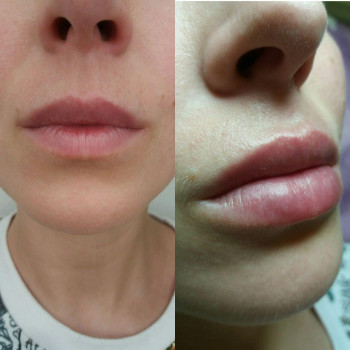 Объемно-контурная пластика: коррекция формы губ
                    Врач-косметолог Натали Молодецкая Одесса