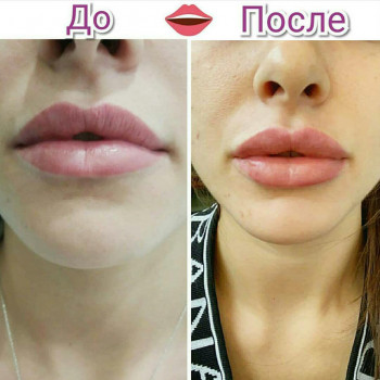 Объемно-контурная пластика: коррекция формы губ
                    Врач-косметолог Натали Молодецкая Одесса