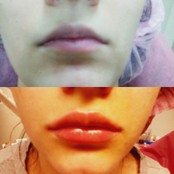 Объемно-контурная пластика: коррекция формы губ
                    Врач-косметолог Натали Молодецкая Одесса