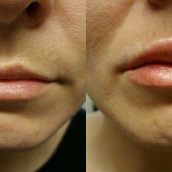 Объемно-контурная пластика: коррекция формы губ
                    Врач-косметолог Натали Молодецкая Одесса