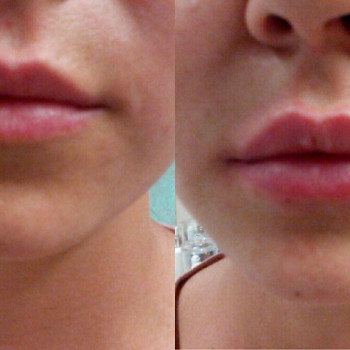 Объемно-контурная пластика: коррекция формы губ
                    Врач-косметолог Натали Молодецкая Одесса