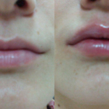 Объемно-контурная пластика: коррекция формы губ
                    Врач-косметолог Натали Молодецкая Одесса