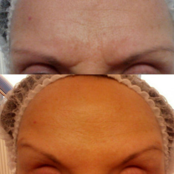 Ботулинотерапия
                    Врач-косметолог Натали Молодецкая Одесса