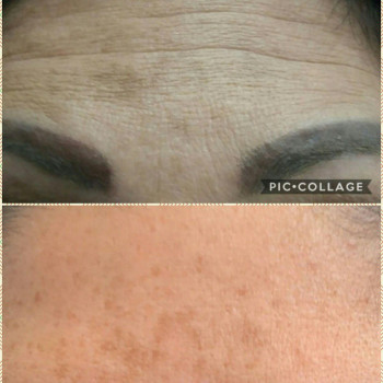 Ботулинотерапия
                    Врач-косметолог Натали Молодецкая Одесса