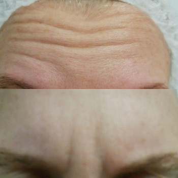 Ботулинотерапия
                    Врач-косметолог Натали Молодецкая Одесса