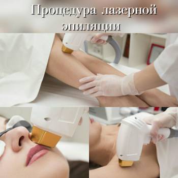 Лазерная эпиляция