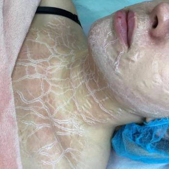 догляд за обличчям, корекціяз моршок