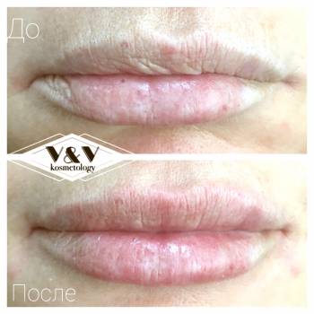 Фото из портфолио косметолога Оксана Вирская (Запорожье)