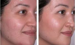 Карбокситерапия Салон красоты Rebelle Одесса