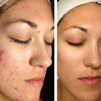 Пилинг лица
                    Салон красоты Rebelle Одесса