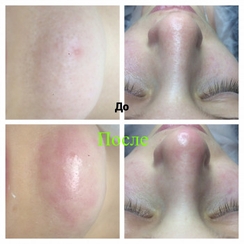 Комбинированная чистка лица
                    Косметолог Оксана Запорожье