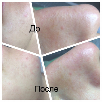 Комбинированная чистка лица
                    Косметолог Оксана Запорожье