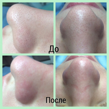 Комбинированная чистка лица
                    Косметолог Оксана Запорожье