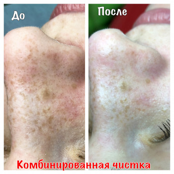 Комбинированная чистка лица
                    Косметолог Оксана Запорожье
