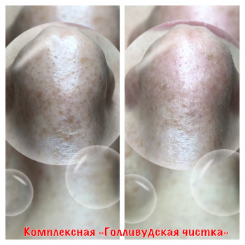 Комбинированная чистка лица
                    Косметолог Оксана Запорожье