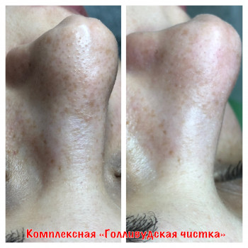 Комбинированная чистка лица
                    Косметолог Оксана Запорожье