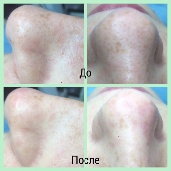 Комбинированная чистка лица
                    Косметолог Оксана Запорожье