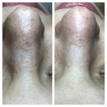 Комбинированная чистка лица
                    Косметолог Оксана Запорожье