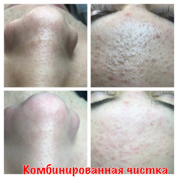 Комбинированная чистка лица
                    Косметолог Оксана Запорожье