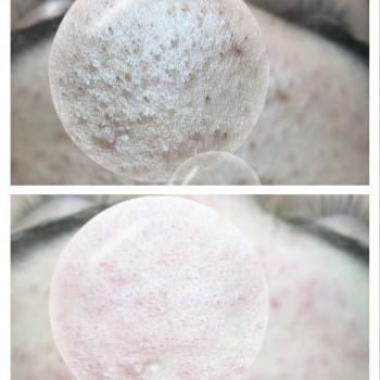 Комбинированная чистка лица
                    Косметолог Оксана Запорожье