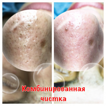 Комбинированная чистка лица
                    Косметолог Оксана Запорожье