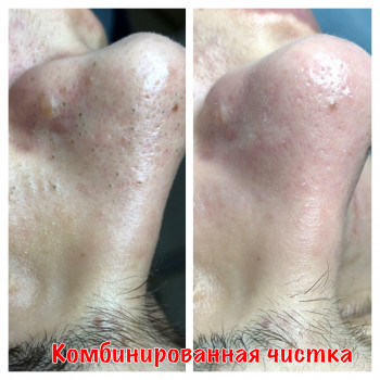 Комбинированная чистка лица
                    Косметолог Оксана Запорожье