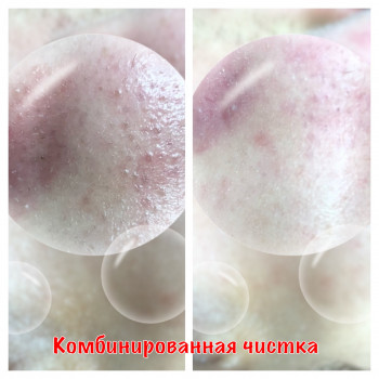Комбинированная чистка лица
                    Косметолог Оксана Запорожье