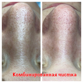 Комбинированная чистка лица
                    Косметолог Оксана Запорожье