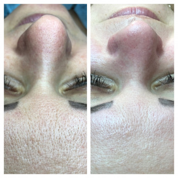 Комбинированная чистка лица
                    Косметолог Оксана Запорожье