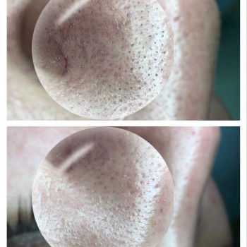 Комбинированная чистка лица
                    Косметолог Оксана Запорожье