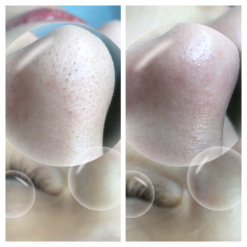 Комбинированная чистка лица
                    Косметолог Оксана Запорожье