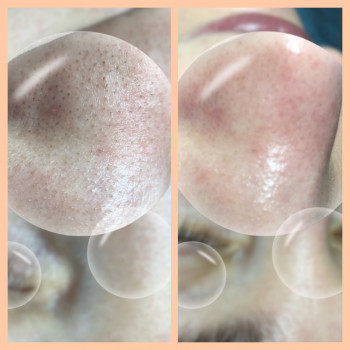 Комбинированная чистка лица
                    Косметолог Оксана Запорожье