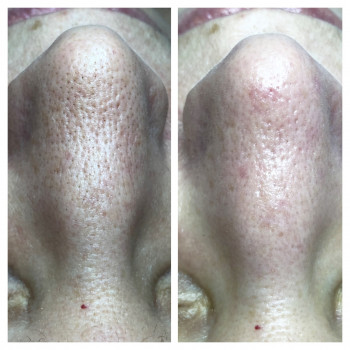 Комбинированная чистка лица
                    Косметолог Оксана Запорожье