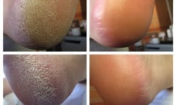 Педикюр кислотный/классический женский Майстер манікюру Татьяна Київ