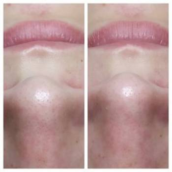 Фото из портфолио косметолога Алла (Кропивницкий)