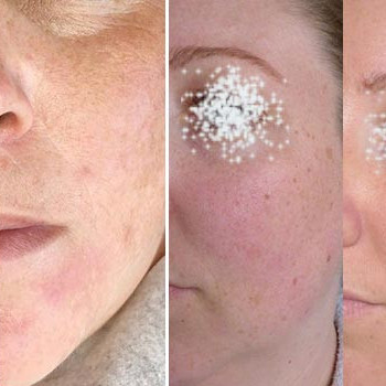 Чистка кожи "Все включено" с аппаратным восстановлением баланса кожи
                    Косметолог Ирина Київ