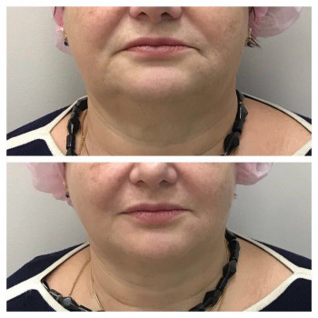 Комплекс "Фракционный RF-лифтинг" лица БЕЗ проколов кожи
                    Косметолог Ирина Киев